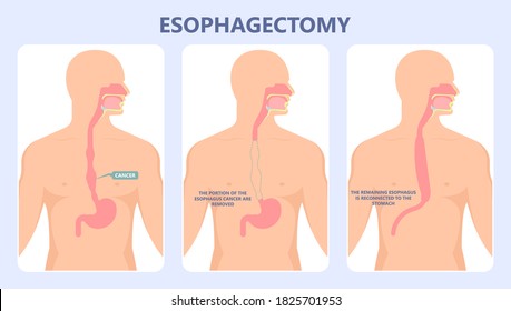 Dysphagia infection trachea examine Surgery choking gastric symptoms diagnose windpipe disorder bleeding surgical GERD treat tumor throat biopsy system ulcers stomach blocked eating food stuck test