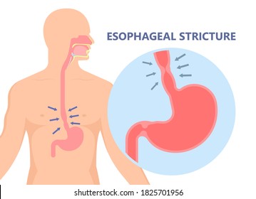 Dysphagia infection trachea examine Surgery choking gastric symptoms diagnose windpipe disorder bleeding surgical GERD treat tumor throat biopsy system ulcers stomach blocked eating food stuck test