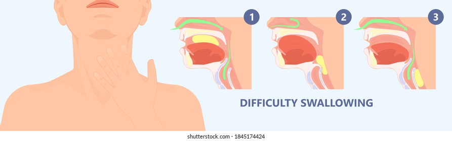 Dysphagia infection trachea examine Surgery choking gastric symptoms diagnose windpipe disorder bleeding surgical GERD treat tumor throat biopsy system ulcers stomach blocked eating food stuck test