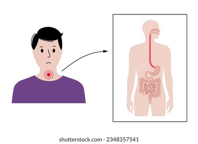 Afiche médico de disfagia. Tragar difícil o doloroso. Concepto de enfermedad esofágica. Dificultad para el paso de sólidos o líquidos de la boca al estómago. Problema del tracto digestivo vector plano