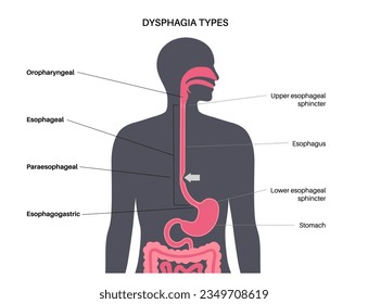 Dysphagia medical poster. Difficult or painful swallowing. Esophagus disease concept. Difficulty in the passage of solids or liquids from the mouth to the stomach. Digestive tract problem flat vector