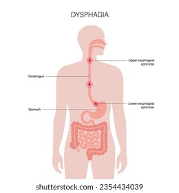 Dysphagia medical poster. Difficult or painful swallowing. Esophagus disease concept. Difficulty in the passage of solids or liquids from the mouth to the stomach. Digestive tract problem flat vector