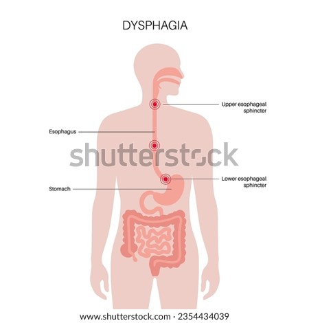 Dysphagia medical poster. Difficult or painful swallowing. Esophagus disease concept. Difficulty in the passage of solids or liquids from the mouth to the stomach. Digestive tract problem flat vector Stock foto © 