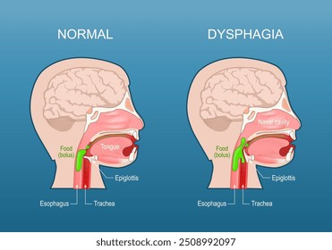 Dysphagia. Swallowing difficulty. Esophageal dysphagia. Aspiration risk. Cross section of a human head with Esophagus, Trachea, Nasal cavity, Tongue, Epiglottis, and Food bolus.  Detailed vector