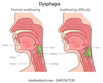 dysphagia swallowing difficulty and normal swallowing with labeled anatomy structure vertebral column diagram hand drawn schematic vector illustration. Medical science educational illustration