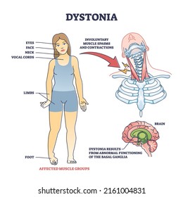 Trastornos de la distonía como espasmos musculares anormales y diagrama de esquema de contracciones. Esquema educativo etiquetado con áreas corporales afectadas y ilustración vectorial de síntomas. Resultado de la disfunción ganglia basal.