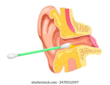 Ear canal cleaning. Ears clean earwax inside with cotton swab, otorhinolaryngology concept earing canal closeup anatomy dirty wax cerumen problem, ingenious vector illustration of earwax ear