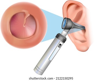Ear examination with an otoscope. Otitis media with effusion: serous otitis media, secretory otitis media. Iinflammation of the eardrum. Otorhinolaryngology