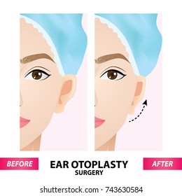 Ear otoplasty surgery before and after vector illustration