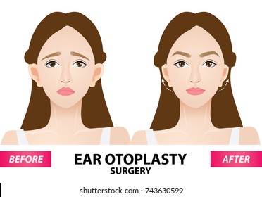 Ear otoplasty surgery before and after vector illustration