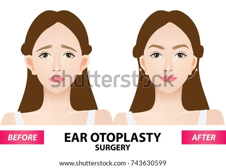 Ear otoplasty surgery before and after vector illustration