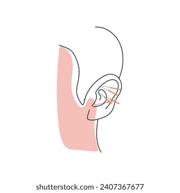 Ear of person undergoing acupuncture on white background