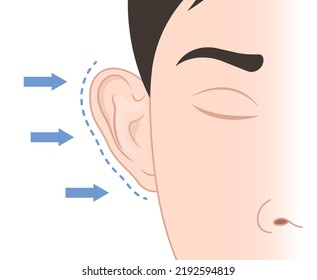 Cirugía de reducción del tamaño del oído el concepto de icono en medicina