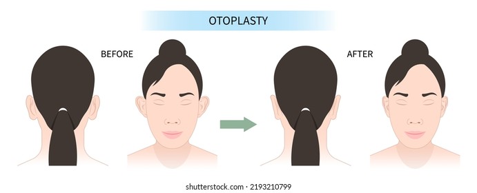 Facelización para la belleza antes y después de la comparación