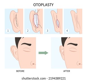 Tipo de sutura quirúrgica médica de los oídos y comparada antes y después