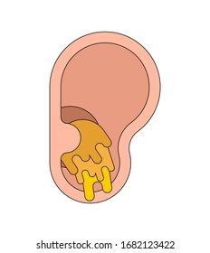 Ear plug Earwax in ear isolated. cerumen vector illustration