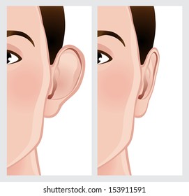 Ear Reshaping. Ear before and after Otoplasty. File is not flattened with labeled layers. Easy to add.