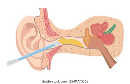 Ohrenschmalz mit Ohrstöpsel-Anatomie