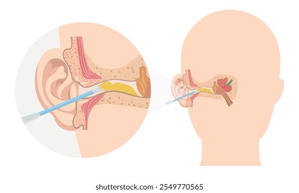 Ohrenschmalz mit Ohrstöpsel-Anatomie