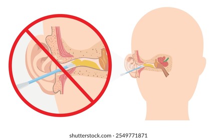 Ear wax with using ear stick anatomy. Warning using q tip