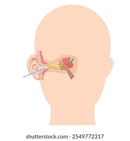 Ohrenschmalz mit Ohrstöpsel-Anatomie