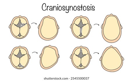 Cierre temprano de las suturas craneales, lo que lleva a un volumen craneal limitado, deformación e hipertensión intracraneal. Enfermedad de los recién nacidos. La cabeza de un niño con diferentes tipos de craneosinostasis.