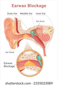 Earwax blockage medical science educational scheme cerumen impaction condition middle or inner ear vector flat illustration. Skin irritation tinnitus and hearing loss cause. Human anatomy education