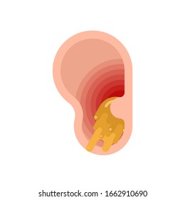 Earwax in ear isolated. cerumen vector illustration