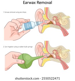 Métodos de extracción de cerumen, incluyendo gotas para los oídos e irrigación con una jeringa de goma para bombillas, para un mejor diagrama de higiene del oído Ilustración vectorial esquemática dibujada a mano. Ilustración educativa de ciencia médica