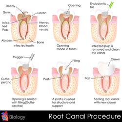 Easy To Edit Vector Illustration Of Root Canal Procedure Of Tooth