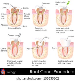 easy to edit vector illustration of root canal procedure of tooth