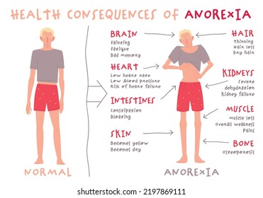 Eating Disorder In Men And Boys. Anorexia Nervosa. Medical Infographic. Abnormal Eating Behavior That Negatively Affects Physical Or Mental Health. Vector Illustration. Graphic Design In Flat Style