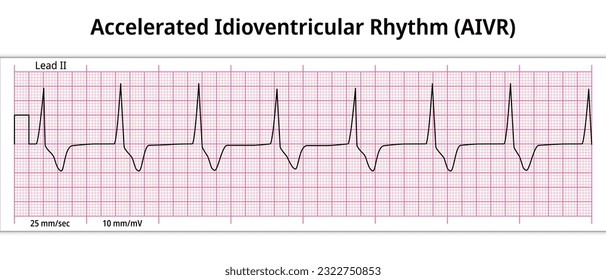 ECG Accelerated Idioventricular Rhythm - 8 Second ECG Paper - Electrocardiography Medical Vector Illustration