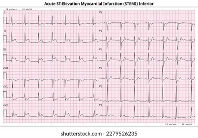 ECG Acute STEMI (ST-Elevation Myocardial Infarction) - 12 Lead ECG Common Case - 6 Sec - Vector Illustration