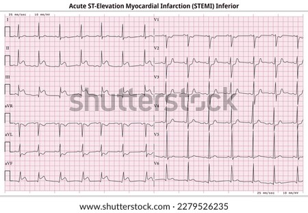 ECG Acute STEMI (ST-Elevation Myocardial Infarction) - 12 Lead ECG Common Case - 6 Sec - Vector Illustration