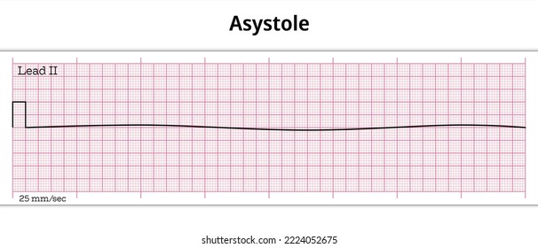 ECG Asystole - 8 Second ECG Paper