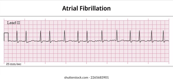 ECG Atrial Fibrillation - 8 Second ECG Paper - Electrocardiography Vector Medical Illustration