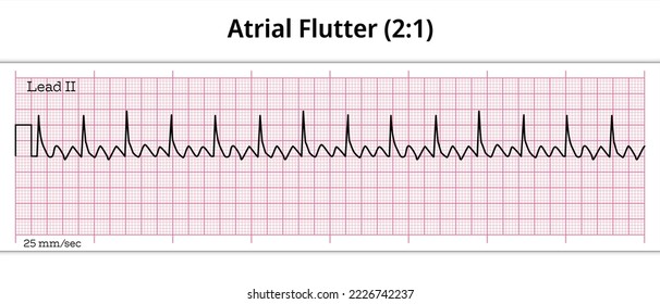 ECG Atrial Flutter (2:1)- 8 Second ECG Paper