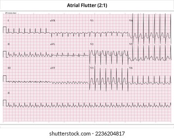 Flutter de ensayo ECG (2:1) - Papel ECG 12 Plomo