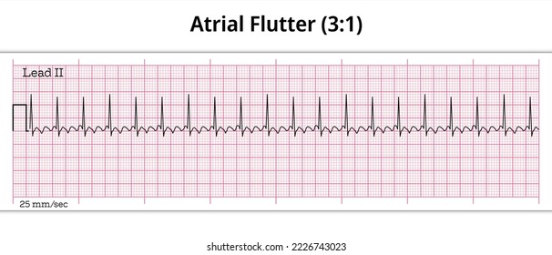 Flutter de ensayo ECG (3:1) - 8 segundos papel ECG