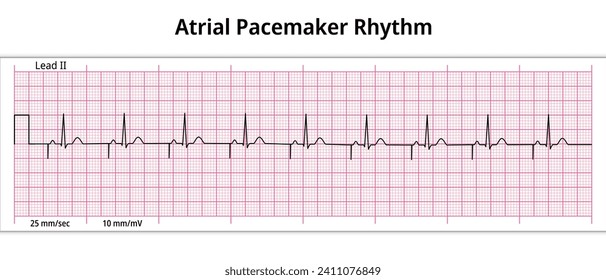 ECG Atrial Pacemaker Rhythm - Single Chamber - 8 Second ECG Paper - Electrocardiography Vector Medical Illustration