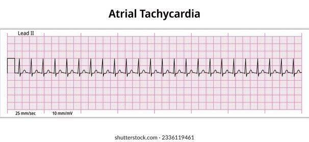 ECG Atrial Tachycardia - 8 Second ECG Paper - Electrocardiography Vector Medical Illustration