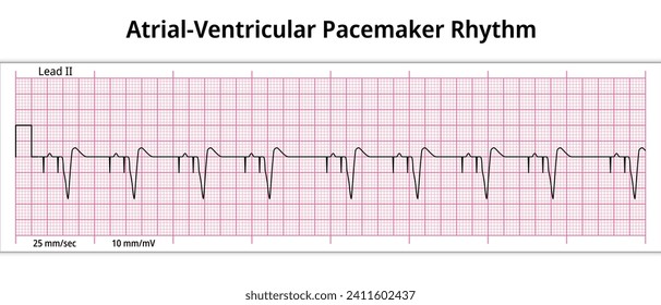 ECG Atrial Ventricular Pacemaker Rhythm - Dual Chamber - 8 Second ECG Paper - Electrocardiography Vector Medical Illustration