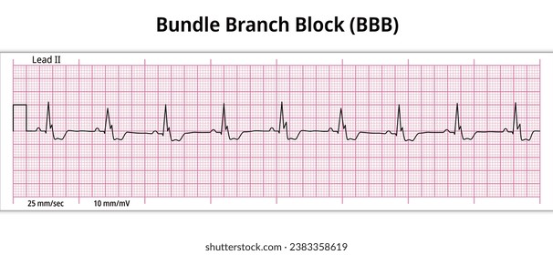 ECG Bundle Branch Block - 8 Second ECG Paper - Electrocardiogram Vector Medical Illustration