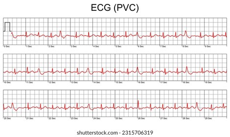 ECG cardiogram.Cardiac Arrhythmia. Premature Ventricular Contraction (PVC). Cardiogram on a white background. Vector illustration.