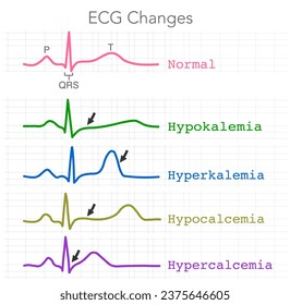 ECG changes. Hypokalemia, Hyperkalemia, Hypercalcemia, Hypocalcemia. Cardiac rhythm. Hearth beat atrial fibrillation. T colored wave p. QRS complex. Illustration vector