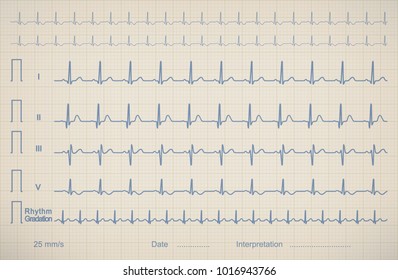 ECG chart image of medical patient, vector illustration