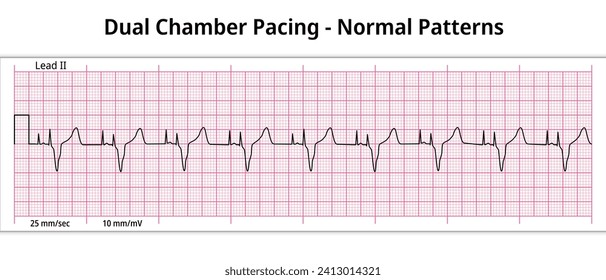 ECG Dual Chamber Pacemaker Rhythm - Normal Pattern - 8 Second ECG Paper - Electrocardiography Vector Medical Illustration