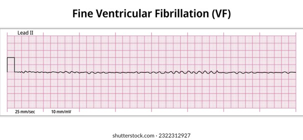 ECG Fine Ventricular Fibrillation - 8 Second ECG Paper - Electrocardiography Medical Vector Illustration