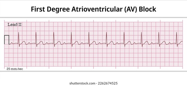 ECG First Degree Atrioventricular Block - 1st degree AV Block - 8 Second ECG Paper - Electrocardiography Vector Medical Illustration